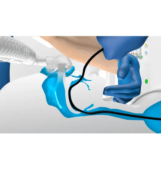 Anatomical illustration of how the SuperNO2VA™ Nasal PAP Ventilation device works.