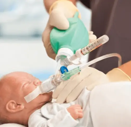 Infant resuscitation with a Vyaire flow-inflating resuscitation device.